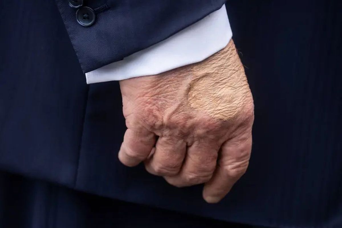 Kaki Trump Bengkak: Insufisiensi Vena Kronis Terungkap